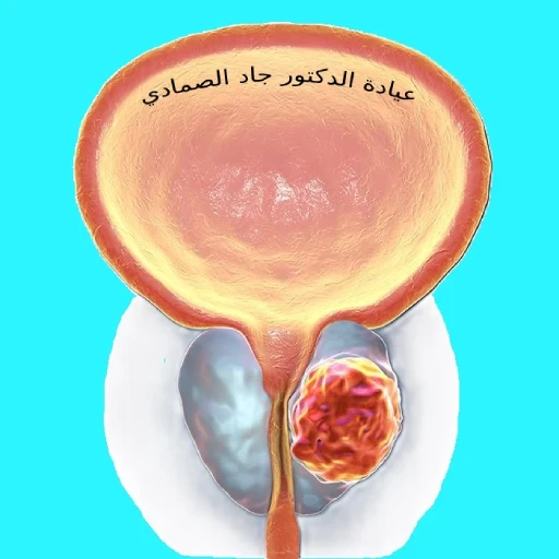 prostate cancer with Dr. Jad Alsmadi تعرف على المزيد عن سرطان البروستات مع الدكتور جاد الصمادي