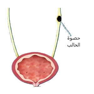   حصوة في الحالب - حصى الحالب - the best ureteral stones image 