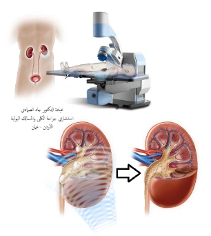 تفتيت حصى الكلى والمسالك البولية بالموجات الصادمة في الأردن عمان مع الدكتور جاد الصمادي