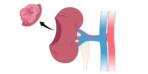   partial Nephrectomy عملية استئصال الكلية الجزئي  